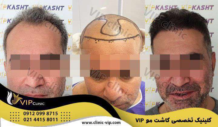 مقایسه انواع روش های کاشت مو Sut سوپر sut و میکرو sut