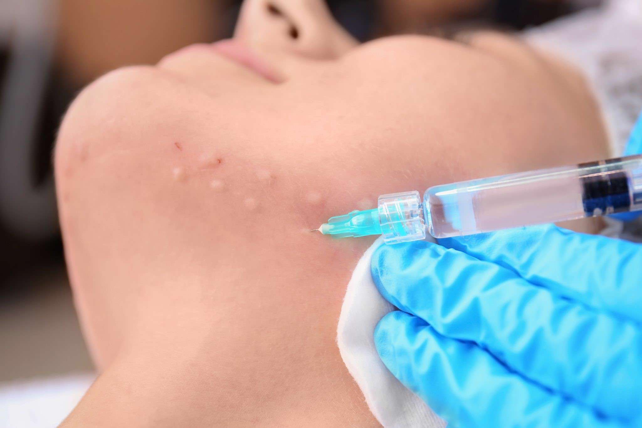 شکل دهی فرم چانه با تزریق ژل