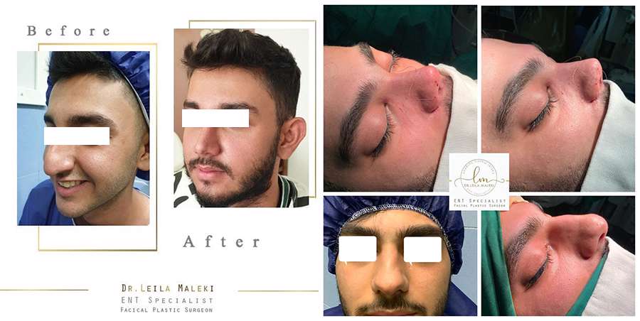 جراحی بینی بدون درد و کبودی واقعیت دارد؟