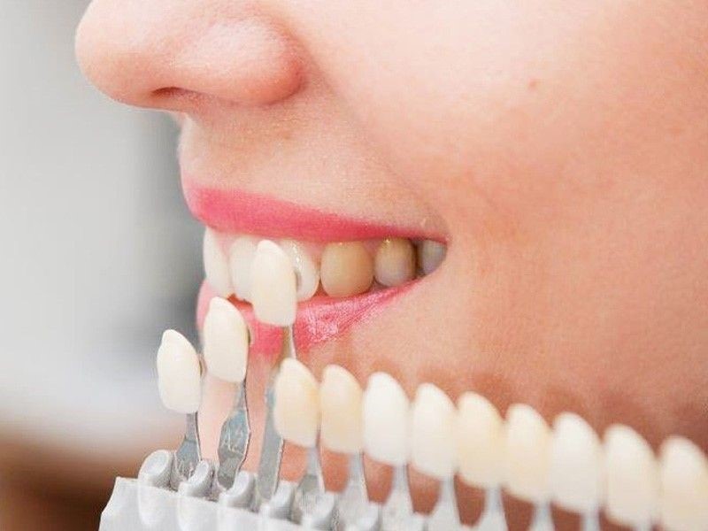 تاثیر لمینت بر زیبایی دندان ها در عصر جدید