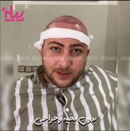 همه چیز درباره هزینه‌ی کاشت مو