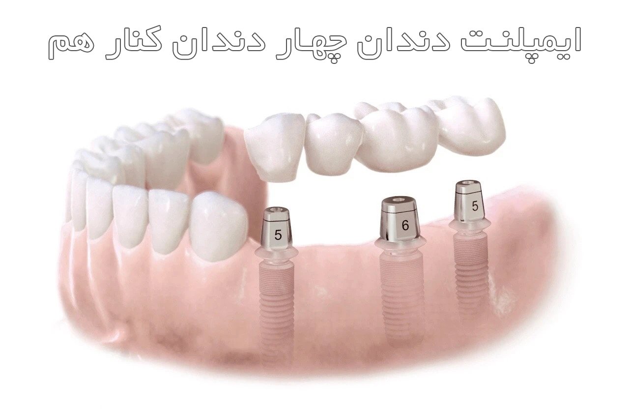هزینه ایمپلنت دو، سه و چهار دندان کنار هم