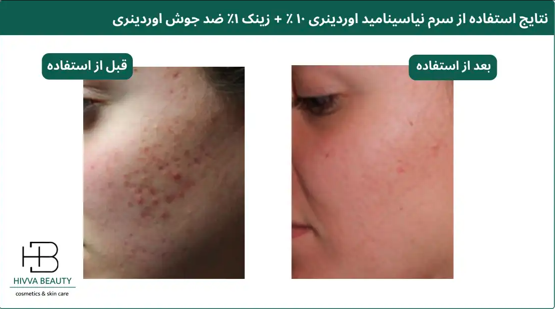 سرم نیاسینامید اوردینری قاتل جوش صورت 