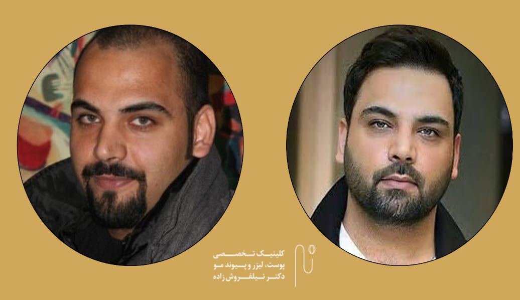 بهترین کلینیک های کاشت مو برای افراد معروف